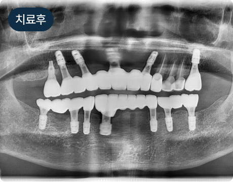 뼈이식 임플란트 치료 후 파노라마 사진