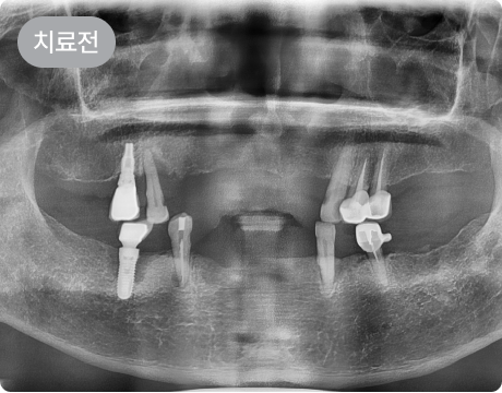 뼈이식 임플란트 치료 전 파노라마 사진