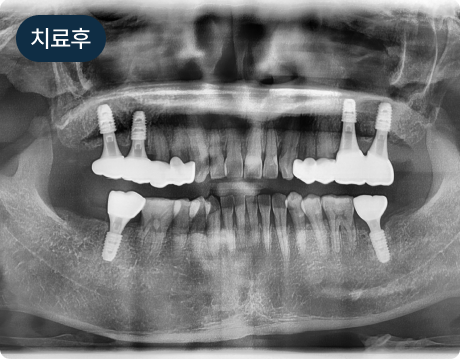 상악동 거상술 임플란트 치료 후 파노라마 사진