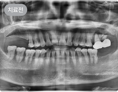 상악동 거상술 임플란트 치료 전 파노라마 사진